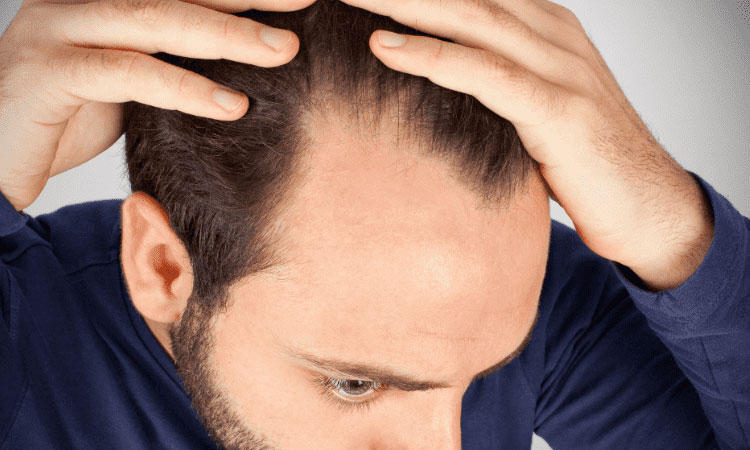 Understanding Hair Loss: Causes, Prevention, and Treatment