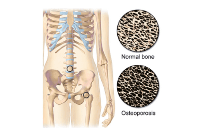 Testosterone and Osteoporosis
